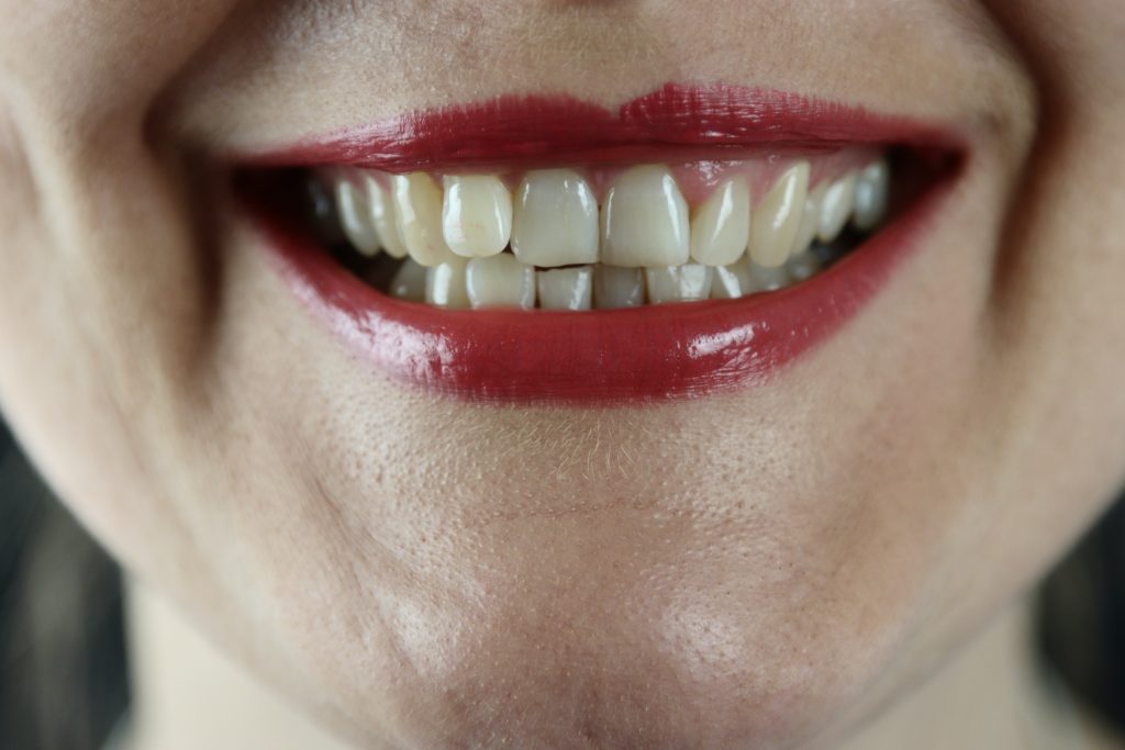 crooked teeth are common dental problems