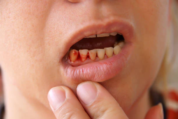 How to Stop Gums From Bleeding in Pineville, NC