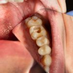 What You Should Know About Tooth Cavity in Pineville, NC