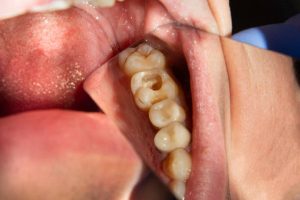 What You Should Know About Tooth Cavity in Pineville, NC