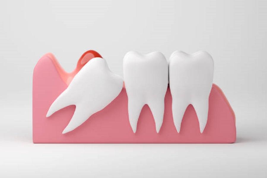 What You Should Know About Wisdom Tooth Extraction in Pineville, NC