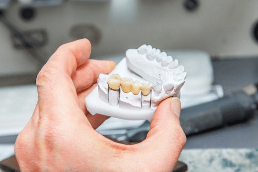 dental crowns and bridges Salisbury NC