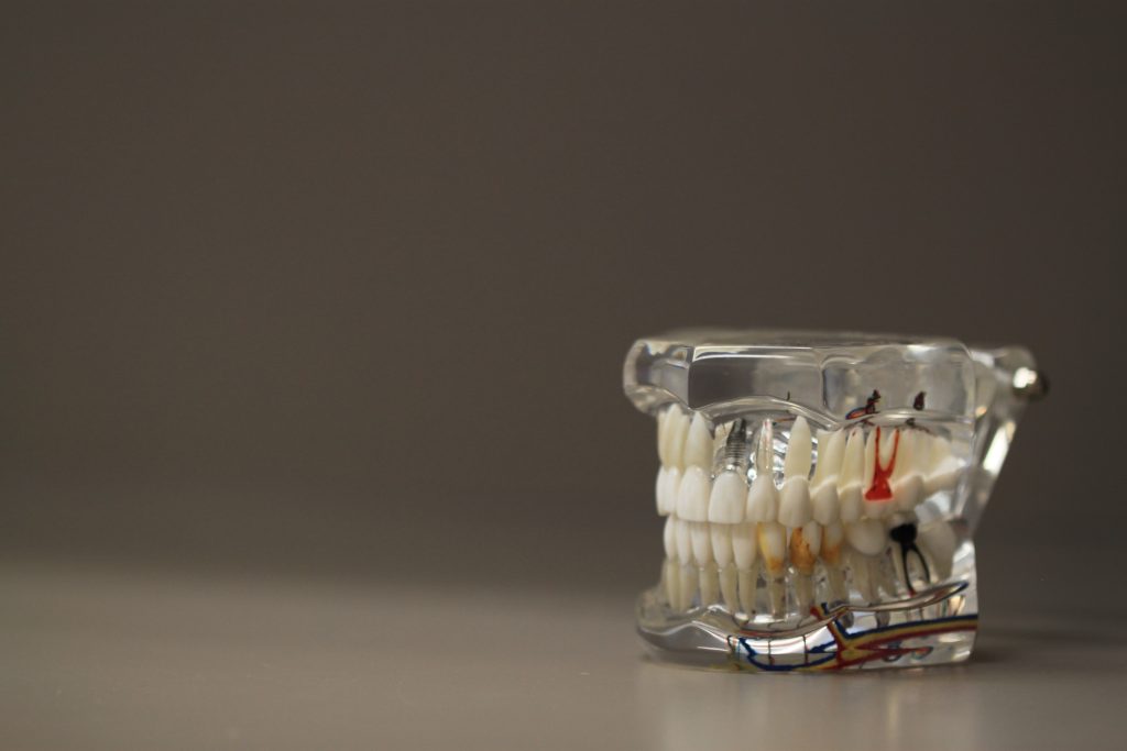 Are You a Good Candidate for Full-Mouth Dental Implants in Pineville, near Charlotte?