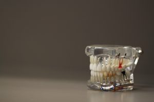 Are You a Good Candidate for Full-Mouth Dental Implants in Pineville, near Charlotte?